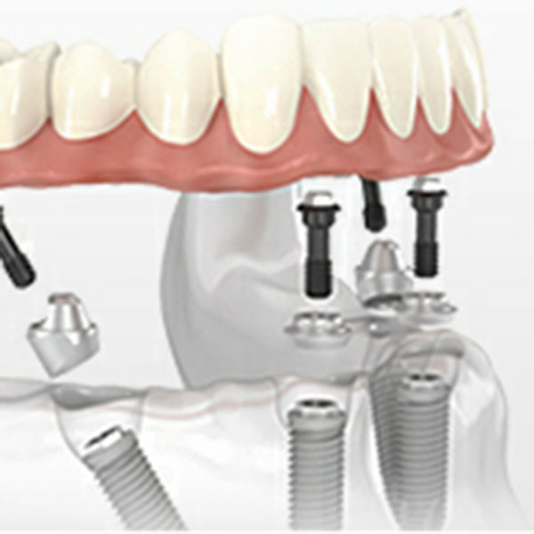 A atrofia óssea bucal é grave?