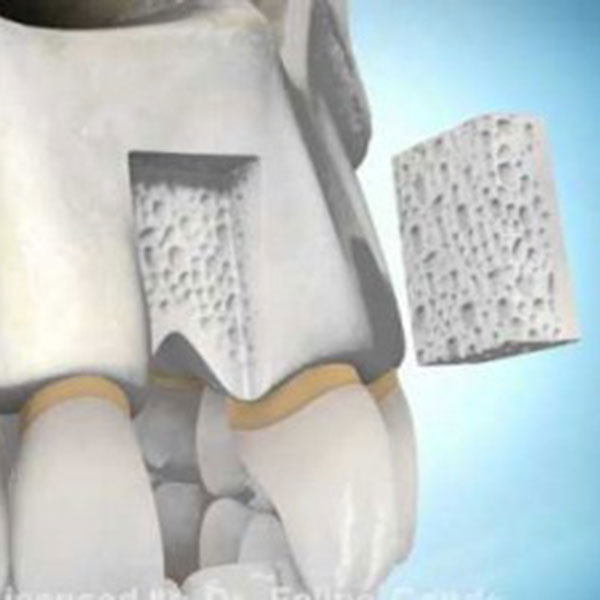 O que é o enxerto ósseo na odontologia?