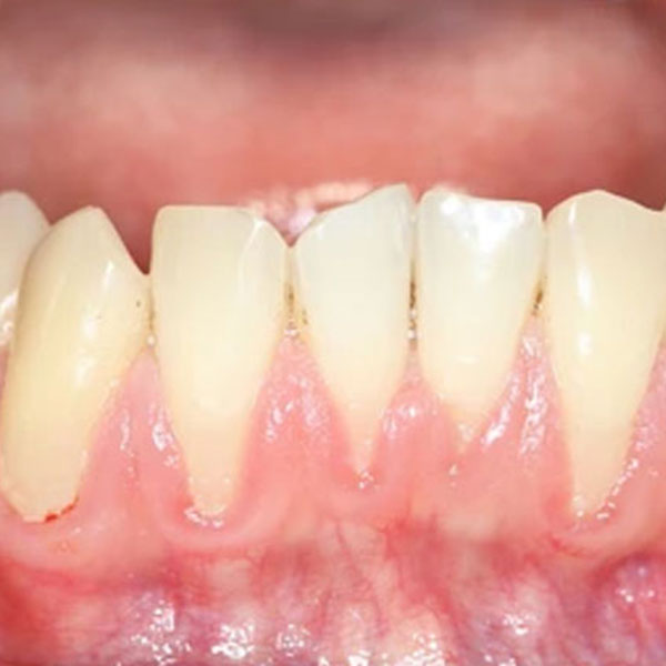 Dentes com Sensibilidade